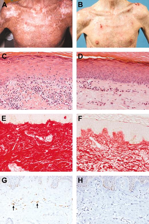 Figure 1. Clinical and histopathological improvement. (A) Patient no. 4 before therapy. (B) Patient no. 4 after therapy. (C) Patient no. 1 before therapy (H&E stain; magnification × 200). Dyskeratotic cells in the epidermis with a mild lymphocytic infiltrate. (D) Patient no. 1 after therapy (H&E stain; magnification × 200). Improvement of the epidermal features. (E) Patient no. 6 before therapy (Sirius red stain; magnification × 200). Compact, severely thickened collagen in the superficial dermis. (F) Patient no. 6 after therapy (Sirius red stain; magnification × 200). The collagen is less compact. (G) Patient no. 6 before therapy (CD68 stain; magnification × 200). A few macrophages are present in the superficial dermis. The arrows in panel G indicate CD68-positive macrophages. (H) Patient no. 6 after therapy (CD68 stain; magnification × 200). The macrophages have disappeared. The microscope used was a Nikon Eclipse E800M with a Nikon Plan apo 20 × objective. The camera used was a digital Nikon FDX-35. Acquisition software and processing software were Nikon ACT-1 and Photoshop, respectively.