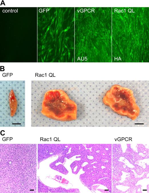 Figure 6. Angioproliferative lesions in RCAS-racQL–injected TIE2-tva mice closely resemble early vGPCR experimental KS lesions. (A) Immunofluorescence of permissive (DF1) chicken fibroblasts infected with RCAS alone (control), RCAS-GFP, RCAS-vGPCR, or RCAS-racQL virus, respectively. Expression of vGPCR or RacQL was detected by staining against AU5 or hemagglutinin (HA) tags, respectively. (B) Representative vascular lesions found in liver from 2 TIE2-tva mice injected with RCAS-racQL (107 IU). Liver from a littermate control injected with RCAS-GFP showed no lesions. Scale bar, 5 mm. (C) Representative hematoxylin and eosin (H&E) staining of liver reveals benign angiectasias similar to those seen in early vGPCR experimental KS lesions. Sections initially photographed at magnification × 40. Scale bar, 50 μm.