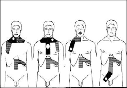 Figure 1. Types of irradiation fields for patients with HL at CS IA and IIA. Black areas received 40 Gy; hatched areas, 30 Gy.