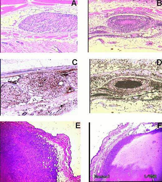 Figure 5. Histochemical analysis of subcutaneous B16F10 and 4T1 tumor cells 10 days after treatment with hirudin, 10 mg/kg 5 minutes before and for 10 days thereafter. Tumor nodules remained fixed and stained with hematoxylin and eosin. (A) B16 F10 contral nodule. (B) B16 F10 nodule of hirudin-treated animal with central necrosis. (C) KI-67 stain of B16 F10 nodule of untreated control nodule. (D) KI-67 stain of B16 F10 nodule from hirudin-treated animal. (E) 4T1 control nodule. (F) 4T1 nodule following hirudin treatment. Representative of 3 different experiments for each tumor. Original magnification × 250 (A-D) and × 1000 (E, F).