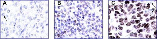 Figure 1. Representative images of FOXP1 immunostaining demonstrate the 3 groups of DLBCLs classified according to FOXP1 expression. Standard streptavidin ABC immunocytochemistry with heat-mediated antigen retrieval was used, with DAB as the chromogen. FOXP1 is visualized in brown. The blue nuclear counterstain is hematoxylin. (A) FOXP1 negative. Occasional cells have very weak expression of FOXP1 (arrow). (B) FOXP1 variable; weak positive. Approximately 50% of the cells express FOXP1 with variable intensity. (C) FOXP1 uniform high expression. One hundred percent of tumor cells show strong, uniform expression of FOXP1. Small lymphocytes are negative (arrows). All images were captured at 60 × magnification using an Olympus Bx50 microscope (Olympus, Tokyo, Japan), a Plan Apo 60×/1.40 oil objective lens (Tokyo, Japan), a Leica DFC-320 digital camera (Leica, Solms, Germany), and associated Leica IM50 software.