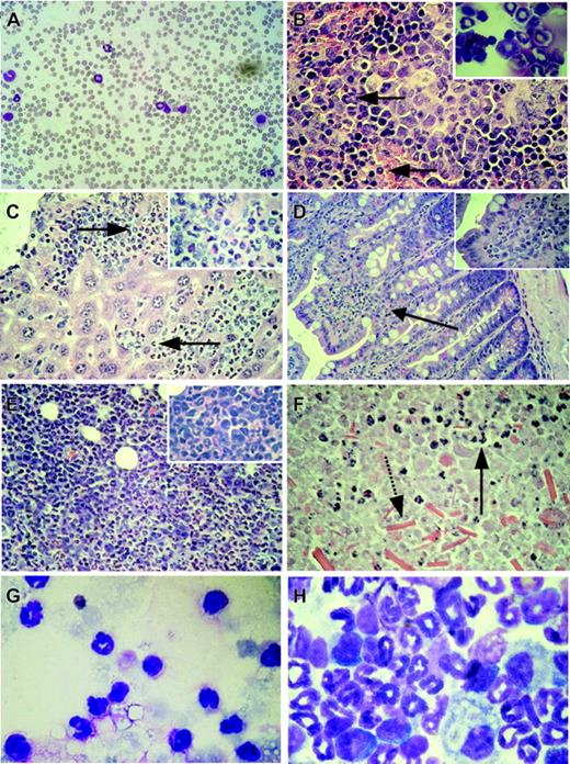 Figure 3. Organ infiltration by myeloid cells after induction of BCR-ABL expression in double-transgenic animals. (A) Peripheral blood smear showing leukocytosis and neutrophilia in a diseased double-transgenic mouse. (B) Histology of the spleen demonstrating extramedullary myeloid hematopoiesis (arrows pointing to myeloid cells). Inset: Myeloid cells in the cytospin of the spleen from the same animal. (C) Histology of the liver. Perivascular infiltration of the liver by hematopoietic cells (arrows point to myeloid cells). Inset: Part of the same organ at higher magnification. (D) Histology of the small intestine showing infiltration of the lamina propria by myeloid cells (arrow, and magnified in the inset). (E) Histology of a kidney from mouse W207 showing disruption of the kidney architecture and massive invasion by hematopoietic cells. Inset: Cells at higher magnification. (F) Histology of the kidney of animal W194 demonstrating parenchymal tissue necrosis with some invading myeloid cells still present (arrow with solid line); note the presence of crystals in the lower part of the picture (arrow with broken line). (G) Fluid recovered from the perinephric cyst of the same animal containing high numbers of neutrophils. (H) Cytospin of the bone marrow showing predominance of myelopoiesis and suppression of the erythroid and lymphoid compartment in the bone marrow. Original magnification, × 60 (B-C) or × 100 (A;D, inset). Original magnifications, × 25 (D), × 60 (A-C, E-F), and × 100 (G-H, insets). Stains were Wright Giemsa for panels A, G, and H, and hematoxylin and eosin for panels B-F.