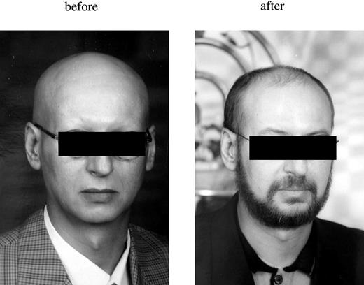 Figure 1. Hair growth. The left panel shows hair growth prior to the patient having been diagnosed with CML; the right panel shows hair growth 3 months after HSCT. Hair growth after transplantation includes the top of the head, as well as the beard and eyebrows.