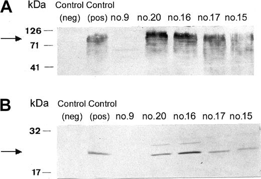 Figure 2. Western blot analysis of neutrophil membranes from the patient and 4 of her daughters. Neutrophil membranes were solubilized and subjected to electrophoresis, blotted, and probed with mAbs against gp91phox (A) or against p22phox (B) as indicated in “Methods.” Lane 1, control neutrophil from a patient with X-CGD; lane 2, control neutrophils from a healthy individual; lane 3, neutrophils from the patient (no. 9); lane 4, neutrophils from daughter no. 20; lane 5, neutrophils from daughter no. 16; lane 6, neutrophils from daughter no. 17; and lane 7, neutrophils from daughter no. 15.