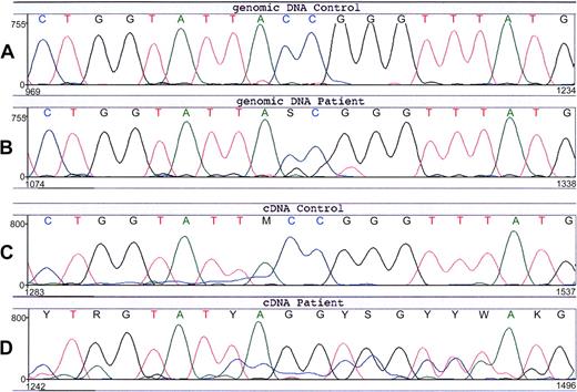 Figure 3. Nucleotide sequence of CYBB around predisposition 88-93 from the patient and a healthy control. (A) Genomic DNA from the leukocytes of a healthy control. (B) Genomic DNA from the leukocytes of the patient (no. 9). The normal CYBB sequence TACCGG is changed in the patient into a mixture with TAGGTG, indicating that she is a heterozygote for this 3-nt mutation. (C) Leukocyte cDNA from a healthy control. (D) Leukocyte cDNA from the patient (no. 9) shows an apparent homozygous mutant sequence TAGGTG. The underlying signal is from another exon, apparently due to some incorrect mRNA splicing.