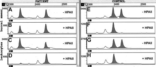 Figure 4. X-chromosome inactivation pattern of the patient and a control with an X-chromosome inactivation defect. DNA was isolated from the leukocytes and from a buccal smear of the patient (no. 9) as well as from the leukocytes and from cultured fibroblasts of a control with an X-chromosome inactivation defect.31 The DNA samples were incubated with or without the restriction enzyme HpaII and subjected to PCR amplification of the HUMARA locus (see “Methods”). The labeled products were separated by size chromatography and scanned for comparison. Panels A and B, DNA from patient (no. 9) buccal smear; panels C and D, DNA from patient (no. 9) leukocytes; panels E and F, DNA from control fibroblasts; panels G and H, DNA from control leukocytes. The patient shows equal inactivation of X chromosomes in the buccal smear but strongly skewed X-chromosome inactivation in the leukocytes. The control shows strongly skewed X-chromosome inactivation in both fibroblasts and leukocytes. Peaks indicated in gray are the main PCR product peaks; those in white are shorter products due to incorrect polynucleotide synthesis. The calculation of skewing percentage (Table 1) is based on the peak heights of the main PCR products.