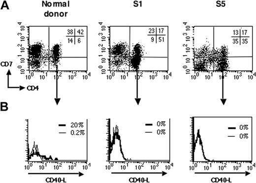 Figure 2. Impaired CD40L induction on SzS tumor cells. (A) PBMCs from healthy donors and patients with SzS were double-stained for CD4 and CD7 expression. Representative dot plots are shown for a healthy donor (left panel), patients S1 (middle panel), and S5 (right panel), which both have a CD4+CD7- tumor. The percentage of labeled cells for each quadrant is indicated in the upper right quadrant. (B) PBMCs were activated with anti-CD3 as in Figure 1. After 6 hours, cells were immunostained for CD40L and analyzed by flow cytometry. Fluorescence histograms are shown for unstimulated (thin lines) and anti-CD3-stimulated (thick lines) gated CD4+CD7-cells.