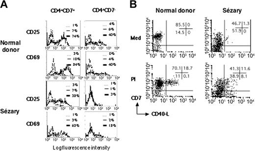 Figure 4. SzS patient tumor cells are refractory to TCR/CD3 signaling. (A) PBMCs from a representative healthy donor and patient S5 were activated with anti-CD3. In patients with SzS who had a CD4+CD7-tumor, nontumor (CD4+CD7+), and tumor (CD4+CD7-), T cells were analyzed for induction of CD25 and CD69 membrane expression upon anti-CD3 stimulation. The counterparts in healthy donors were also analyzed. Fluorescence histograms are shown for unstimulated cells (thin lines) and anti-CD3-stimulated cells (thick lines). Dashed lines represent isotype-control staining of unstimulated cells. Similar results were obtained in 2 other patients with SzS. (B) PBMCs from a healthy donor and patient S5 were cultured in medium alone or activated with PMA/ionomycin (PI) for 6 hours. CD40L induction was monitored by flow cytometry. Dot plots for CD7 and CD40L staining are shown. The tumor T cells in the patients with SzS are contained in the CD7- fraction. The percentage of labeled cells for each quadrant is indicated in the upper right quadrant. Similar results were obtained in 3 other patients with SzS.