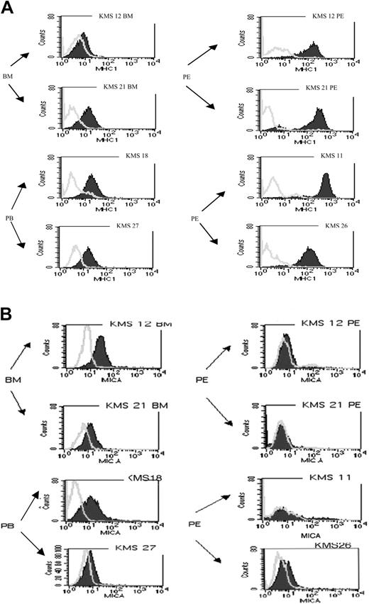 Figure 2. Reciprocal surface expression of MHC class I and MICA between bone marrow- and pleural effusion-derived myeloma cell lines. (A) BM, PB, and PE myeloma cell lines were stained with isotypic mAb control (open curves) or with anti-MHC class I antibody (filled area). A clear overexpression of MHC class I molecule is detected in PE cell lines (1 of 5 representative experiments). (B) Staining obtained using BAM195 anti-MICA antibodies: MICA expression is detectable in BM cell lines but not in PE cell lines. Similar results were obtained using the anti-MICA-MICB antibody 6D4.