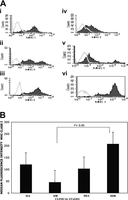 Figure 6. Heterogeneous MHC class I molecule expression on freshly isolated CD38+ and CD138+/CD38+ bone marrow myeloma cells. Staining profile of MHC class I expression on patients 2, 3, 4, 5, 6, and 10 derived CD38+ cells are reported in panels i, ii, iii, iv, v, and vi, respectively (A). It should be noted that in patients 2 and 3 the myeloma cells were stained equally well by either anti-CD38 or anti-CD138 mAbs; for p10 MHC class I expression was tested on immunomagnetic-purified CD38+/CD138+ myeloma cells, and for patients 4, 5, and 6 CD38bright cells were gated. At least 10 000 events were analyzed within the CD38+bright or the CD38+/CD138+ gated cells. Open curves are the isotypic control; close curves are W6-32 staining. The correlation between myeloma clinical stages and MHC class I expression was analyzed (B). Stage IIA (n.4), stage IIB (n.2), stage IIIA (n.5), and stage IIIB (n.3). The differences between stage IIB and IIIB reached statistical significance with P of 05 or less. The analysis was performed via gating on living MHC class I-positive myeloma cells.