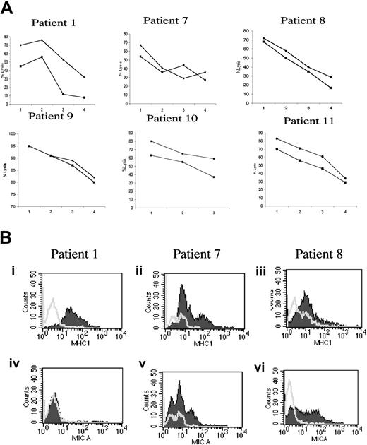 Figure 7. Autologous NK cells recognize freshly explanted bone marrow myeloma cells. (A) Freshly explanted autologous NK and myeloma cells were used in cytotoxicity assays. The results obtained in patients 1, 7, 8, 9, 10, and 11 are shown. ♦ indicates recognition by autologous fresh NK cells; •, percentage of lysis obtained using as effectors IL-2 activated autologous NK cells. The E/T ratios used were 25:1 (1), 12:1 (2), 6:1 (3), and 3:1 (4). Myeloma cells from patient 10 were obtained by immunomagnetic selection using BB-4 (anti-CD138) mAb and kept without exogenous IL-6 treatment. Five of 6 patients showed a very high autologous NK recognition of BM-derived myeloma cells, while patient 1 had less efficient autologous myeloma elimination. In patient 1, 10, and 11, IL-2 activation of NK cells had a beneficial effect on autologous myeloma recognition. (B) CD38+ cells from bone marrow aspirates were double stained with anti-MHC class I, W6-32 (i-iii) or anti-MICA, BAM195 (iv-vi) antibodies. Open areas are isotype controls; filled areas are specific antibody staining. Patient 1 had higher MHC class I expression than patient 7 and patient 8, while MICA was not detectable. Patient 7- and patient 8-derived myeloma cells were readily stained with anti-MICA antibody. After subtracting the background value the MHC class I surface expression median value for the patients 1, 7, and 8 were, respectively, 30, 8, and 10, while the MICA median values were 3, 10, and 8. For patients 9, 10, and 11 it was not possible to evaluate the complete phenotype because of the limited number of cells obtained.