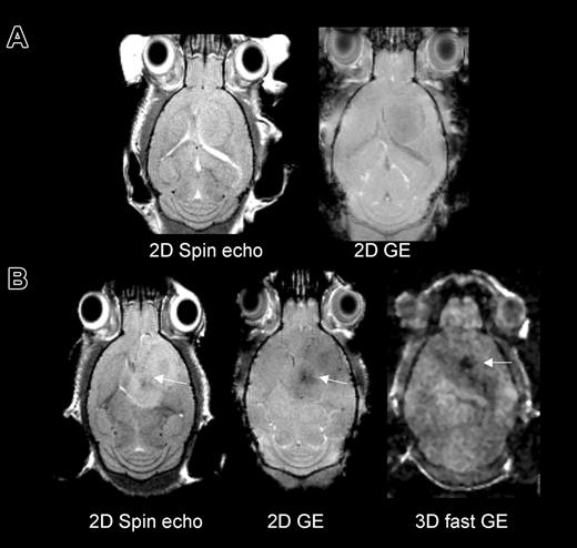 Figure 1. MRI in mice that received either no cell transplant or magnetically labeled Sca1+ bone marrow cells at day 5 of tumor growth and were imaged 7 days later to investigate detection of labeled cells by several MRI techniques. (A) Mouse with 12-day tumor and no cell transplant on 2D spin echo and gradient echo (GE) images. (B) Mouse with 12-day tumor and 7 days from labeled cell transplant on spin echo, GE, and fast GE images. Hypointense areas in the tumor were detectable with all sequences in the labeled mouse. The fast gradient echo had the greatest sensitivity to iron and the least anatomic definition.