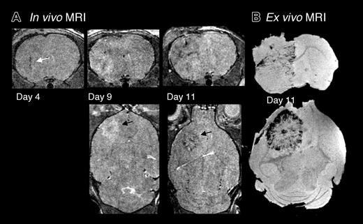 Figure 2. Serial MRI in mice that received magnetically labeled Sca1+ bone marrow cells, group 2. (A) 3D RARE images showing evolution of hypointense regions within and around tumor, due to incorporation of labeled cells into vascular structures or within parenchyma of tumor. Arrowheads indicate needle tract on day 4 after tumor implantation and growing tumor area on days 9 and 11. Hypointense areas in and around the tumor are evident at day 9, and a hypointense rim surrounding the tumor is observed on day 11. (B) Ex vivo gradient echo MRI of the same mouse at day 11.