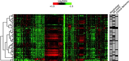 Figure 1. Unsupervised clustering of 72 FL samples, grades 1, 2, and 3, shows a relative biologic homogeneity of FL. There is a separation in 3 main groups with no enrichment for morphologic grades or clinical behavior in either of the groups. Each row represents a tumor and each column a single gene. Gene expression is depicted according to the color bar. Red indicates a high level of mRNA expression relative to the reference and green indicates a low level of expression. Selected morphologic and clinical data are depicted in the right panel. For clinical features, □ indicates indolent and ▪ indicates aggressive disease behavior (Table 1 lists criteria). For morphologic grading, □ indicates grade 1; ▨, grade 2; and ▪, grade 3. For IPI, □ denotes scores 0, 1, or 2, and ▪, 3, 4, or 5. ▦ denotes insufficient data.