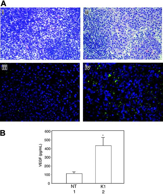 Figure 7. Lymph nodes from K1 transgenic mice showing sheets of plasma cells and loss of normal architecture and increased VEGF production as detected by immunohistochemical staining and ELISA. (A) Lymph node tissue sections from a nontransgenic mouse (Ai) and a K1 transgenic mouse (Aii) were stained with hematoxylin and eosin and examined under a light microscope. Immunohistochemically stained sections of a lymph node from a nontransgenic mouse (Aiii) and a K1 transgenic mouse (Aiv) with anti–VEGF antibody were examined under a deconvolution microscope as described in “Materials and methods.” The original magnification was ×400. Results are representative of 3 separate experiments. (B) Equal weights of minced lymph nodes from nontransgenic (NT) and K1 transgenic mice were cultured overnight in 1 mL growth medium, and the VEGF levels were analyzed in 50-μL aliquots of culture supernatants by ELISA. Results represent the means (± SD) of VEGF concentrations in lymph nodes from 6 mice per group. There were statistically significant increases in VEGF concentration in the lymph nodes from K1 mice (*P = .009).