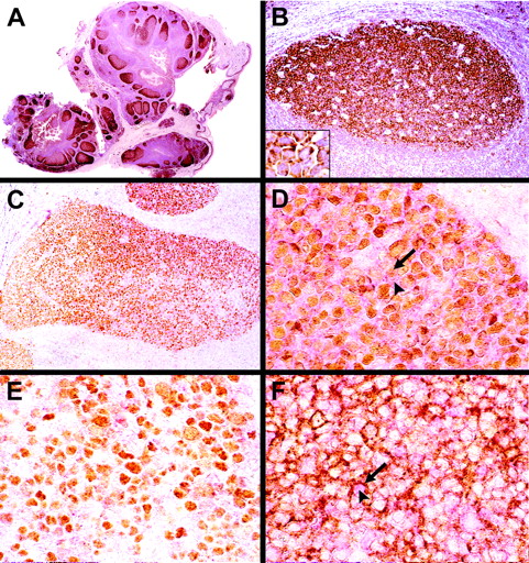 Figure 3. Immunohistochemical staining with anti-HGAL monoclonal antibody in tonsil tissues. (A-B) GCs are highlighted in a normal tonsil; an increased intensity of staining is seen within cells of the proliferating pole or dark zone of GCs, whereas mantle and marginal zones lack staining. Inset shows a higher magnification of HGAL staining in germinal-center cells. (C) Double immunohistologic labeling for HGAL (red cytoplasmic stain) and BCL6 (brown nuclear stain) are colocalized in a significant number of cells within the GC. (D) A subset of GC cells shows coexpression of BCL6 (arrow) and HGAL (arrowhead). (E) A subset of GC cells located in the proliferative pole of the GC shows staining for BCL6 but not for HGAL. (F) Double immunohistologic labeling for HGAL (red cytoplasmic stain, arrowhead) and CD10 (brown membrane stain, arrow) show that a majority of GC cells coexpress these 2 proteins although cells expressing only HGAL or CD10 are also present. Original magnifications: A, ×30; B and C, ×150; D-F and B inset, ×600.