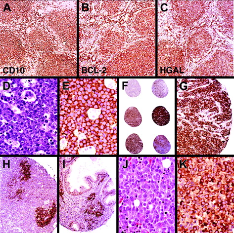 Figure 4. Immunohistochemical staining with anti-HGAL monoclonal antibody in lymphomas. (A-C) Follicular lymphoma stained with the CD10, BCL2, and anti-HGAL monoclonal antibody highlights neoplastic follicles and interfollicular B cells. (D) Hematoxylin and eosin-stained section of Burkitt lymphoma shows uniform cells admixed with starry sky histiocytes. (E) Burkitt lymphoma cells show staining for HGAL protein. (F) TMA cores of DLBCL show a range of staining from none to weak/partial staining to intense staining of all neoplastic cells. (G) High magnification of a core of a DLBCL shows moderate to strong staining within the cytoplasm. (H-I) Extranodal marginal zone B-cell lymphoma of the lymph node and gastrointestinal tract lacks staining for HGAL although the stain highlights entrapped GCs within the neoplastic infiltrate. (J) Hematoxylin and eosin–stained section of plasma cell myeloma shows sheets of atypical plasma cells with prominent nucleoli. (K) Plasma cell myeloma shows staining for HGAL protein. Original magnifications: A-C, H, and I, ×150; F, ×30; G, ×300; D, E, J, and K, ×600.