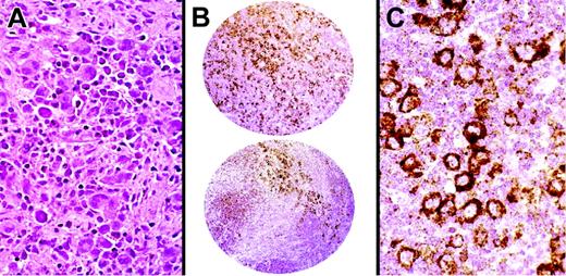 Figure 5. HGAL staining in Hodgkin lymphoma. Immunohistochemical staining for HGAL protein highlights large atypical cells in a case of nodular sclerosis Hodgkin lymphoma on 2.0-mm cores on a TMA. The staining is localized within the cytoplasm of Hodgkin cells. Original magnifications: A and C, ×30; B, ×600.