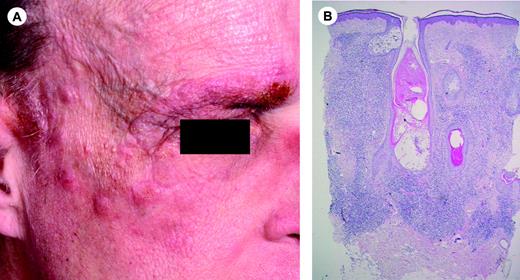 Figure 2. Follicular mycosis fungoides. (A) Infiltrated plaques on the forehead and right eyebrow showing hair loss. (B) Diffuse dermal infiltrate surrounding follicular structures. Note infiltrate-free zone beneath epidermis (no epidermotropism) (H&E staining; original magnification, × 25). Image acquisition was performed as described for Figure 1B. An HC FLUOTAR 2.5×/0.07 objective was used.