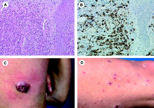 Figure 3. Primary cutaneous CD30+lymphoproliferative disease (pcCD30+ LPD). (A) Diffuse dermal infiltrate of large atypical cells admixed with small lymphocytes. (H&E staining; original magnification, × 300). (B) The large atypical cells are strongly positive for CD30. (C-D) The histologic picture in panels A and B can be found both in C-ALC and in LyP. The final diagnosis depends on the clinical presentation. In combination with the solitary tumor of the patient shown in panel C the definite diagnosis will be C-ALC; in combination with recurrent, self-healing papulonecrotic skin lesions (D), the final diagnosis is LyP. Image acquisition for panels A and B was performed as described for Figure 1B. An HC Plan APO 20×/0.70 objective was used.