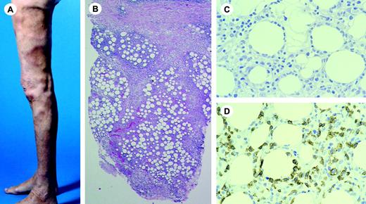 Figure 4. Subcutaneous panniculitis-like T-cell lymphoma. (A) Deeply seated nodular skin lesions and residual lipodystrophy after disappearance of the skin lesions. (B) Infiltrates are almost exclusively localized in subcutaneous tissue resembling a lobular panniculitis (H&E staining; original magnification, × 25). (C) Rimming of individual fat cells by neoplastic T cells (H&E staining; original magnification, × 480). (D) Tumor cells show positive staining for CD8. Image acquisition for panels B-D was performed as described for Figure 1B. An HC FLUOTAR 2.5×/0.07 objective was used for panel B; an HC Plan APO 40×/0.85 objective was used for panels C and D.