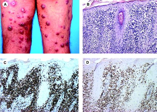 Figure 5. Primary cutaneous aggressive epidermotropic CD8+ cytotoxic T-cell lymphoma. (A) Typical presentation with nodules and tumors showing central ulceration. (B-D) Tumor cells show striking epidermotropism (H&E staining; original magnification, × 150), and strongly express CD8 (C) and TIA-1 (D). Image acquisition for panels B-D was performed as described for Figure 1B. An HC Plan APO 10×/0.40 objective lens was used.