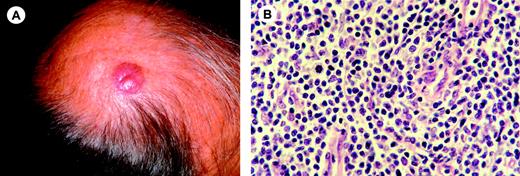 Figure 6. Primary cutaneous CD4+ small/medium-sized pleomorphic T-cell lymphoma. (A) Presentation with a solitary tumor on the scalp. (B) Diffuse dermal infiltrate mainly composed of small pleomorphic T cells with few scattered blasts cells (H&E staining; original magnification, × 750). Image acquisition was performed as described for Figure 1B. An HC FLUOTAR 63×/0.90 objective lens was used.
