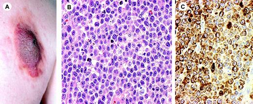 Figure 7. CD4+/CD56+ hematodermic neoplasm (blastic NK-cell lymphoma). (A) Presentation with large tumor on the back. (B) Monotonous infiltration of medium-sized tumor cells (H&E staining; original magnification, × 480). (C) The tumor cells strongly express CD56. Image acquisition for panels B and C was performed as described for Figure 1B. An HC Plan APO 40×/0.85 objective lens was used.