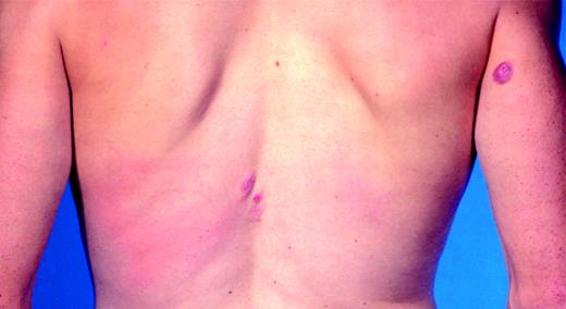 Figure 8. Primary cutaneous marginal zone lymphoma. Characteristic clinical presentation with multiple nodules and small tumors on the back and arms.