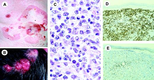 Figure 9. Primary cutaneous follicle center lymphoma. (A) Typical presentation with tumors on the chest surrounded by less infiltrated erythematous skin lesions. (B) Presentation with multiple tumors confined to the scalp. (C) Diffuse dermal infiltrate mainly consisting of large centrocytes and multilobated cells (H&E staining; original magnification, × 480). (D-E) Serial sections stained for CD20 (D) and bcl-2 (E). Bcl-2 is expressed by perivascular T cells, but not by the neoplastic B cells. Image acquisition for panels A and C-E was performed as described for Figure 1B. An HC Plan APO objective was used (40×/0.85 for panel C; 10×/0.40 for panels D and E).