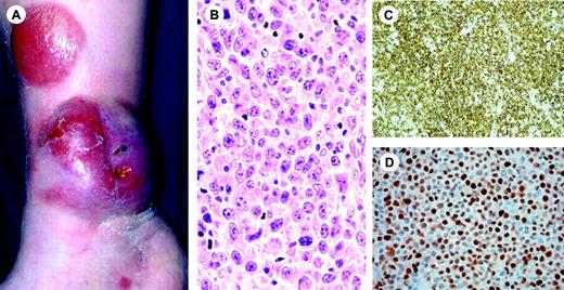 Figure 10. Primary cutaneous diffuse large B-cell lymphoma, leg type. (A) Clinical presentation with multiple tumors on right lower leg. (B) Monotonous proliferation of centroblasts and immunoblasts (H&E staining; original magnification,× 480). (C-D) Characteristically, the neoplastic B cells strongly express bcl-2 (C) and Mum-1/IRF-4 (D). Image acquisition for panels B-D was performed as described for Figure 1B. An HC Plan APO objective was used (40×/0.85 for panel B; 20×/0.70 for panels C and D).