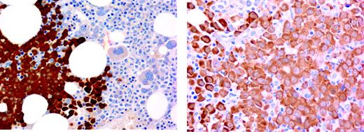 Figure 2. BM biopsy stained with B9.8 shows strong expression of NY-ESO-1 protein in myeloma plasma cells. Images (left panel, original magnification × 10, numerical aperture 0.3; right panel, original magnification × 20, numerical aperture 0.46) were visualized with an Olympus microscope, type BH2-RFCA. Images were acquired with a SPOT camera (Diagnostics Instruments, Sterling Heights, MI) and SPOT Advanced version 3.5.6 software without image manipulation.