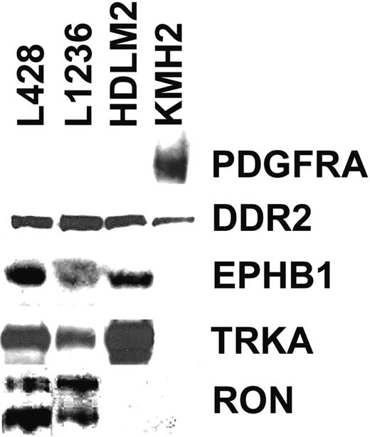 Figure 1. Western blot analysis for expression of 5 RTKs in 4 HRS cell lines. Shown are Western blots of all 4 analyzed HRS cell lines for PDGFRA, DDR2, EPHB1, TRKA, and RON. All bands shown are of expected size. In the RON Western blot, the shorter band corresponds to the processed β-chain and the longer band to the unprocessed precursor.