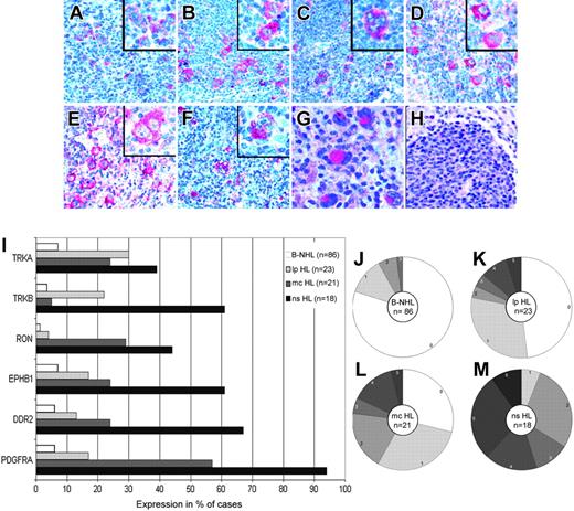 Figure 2. Immunohistochemical analysis of PDGFRA, DDR2, EPHB1, RON, TRKB, and TRKA expression. Immunohistochemical analysis of patients with primary HL using alkaline phosphatase and Fast Red as substrate revealed the HRS cell–specific expression of PDGFRA (A), DDR2 (B), EPHB1 (C), RON (D), TRKB (E), and TRKA (F). In positive patients, most HRS cells were stained. In a clonally related composite lymphoma, PDGFRA-specific staining was observed in the HRS cells (G) but not in the follicular lymphoma cells (H). All magnifications are 200×; those in the inserts are 400×. (I) The percentages of patients with B-NHL (n = 86; 22 mantle cell lymphomas, 15 chronic lymphocytic leukemias, 19 follicular lymphomas, 11 Burkitt lymphomas, 19 diffuse large B-cell lymphomas), LP HL (n = 23), MC HL (n = 21), and NS HL (n = 19) expressing the indicated RTKs are shown. (J-M) Pie charts showing the breakdown of patients expressing the indicated numbers of RTKs for B-NHL (J) (n = 86), LP HL (K) (n = 23), MC HL (L) (n = 21), and NS HL (M) (n = 19).