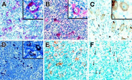 Figure 3. Analysis of RTK activation with p-Y–specific antibodies. Immunohistochemical analysis with antibodies specific for p-Y-720-PDGFRA (A) and p-Y-680/681-TRKA and -TRKB (B), using alkaline phosphatase and Fast Red as substrate, showed considerable HRS cell–specific staining in patients expressing the respective RTKs. In positive patients, only a fraction of HRS cells (approximately 30%-70%) was stained. Positive and negative cells were intermingled. Immunostainings with a pan-p-Y antibody using horseradish peroxidase and diaminobenzidine (DAB) as substrate revealed elevated levels of p-Y contents, comparable to tumors with activated RTKs, in the HRS cells of several patients (C-E). The same patient with HL is shown in panels E and F. (E) HRS cells are positive, (F) and pretreatment of the section with T cell phosphatase abolished staining completely. All magnifications except panel D are 200×, with magnifications in inserts at 400×. Magnification in panel D is 100×.