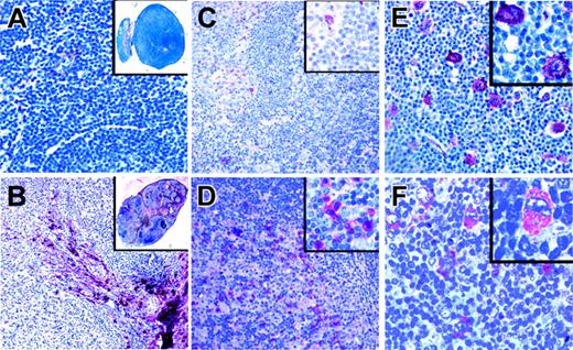 Figure 4. Immunostaining of classical HL for ligands of aberrantly expressed RTKs. Immunostaining of a lymph node with reactive lymphoid hyperplasia (A) and of a classical HL (B) for collagen type 1, the high-affinity ligand for DDR2, using alkaline phosphatase. Although only the capsule and occasional vessels are stained in lymphadenitis, sclerotic bands containing collagen type 1 and branching into the tumor infiltrate are numerous in HL. Immunostaining of a lymph node in a patient with reactive hyperplasia (C) and classical HL (D) for NGF, the TRKA ligand. NGF-positive cells were rarely observed in the reactive lymph node, whereas such cells were frequent in the tumor infiltrate. (E) Immunostaining of a classical HL for PDGFA, a high-affinity ligand for PDGFRA. PDGFA is expressed by HRS cells in a patient also expressing PDGFRA. (F) Immunostaining in a patient with classical HL for EphrinB1, a ligand for EPHB1, found to be expressed by HRS cells of several patients expressing EPHB1. All magnifications are 100×. Inserts in panels A and B are 0.5×; those in panels C-F are 400×.