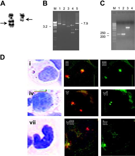 Figure 1. The detection of a novel MLL rearrangement and combined analysis of morphology and FISH of the bone marrow cells in the myeloid lineage. (A) Partial karyotype (G-banding) for the t(11;11)(q13;q23). Both chromosomes 11 are shown. The arrows indicate the breakpoints in the rearranged chromosomes. (B) Genomic DNA of the patient analyzed by the long-distance inverse–polymerase chain reaction (LDI-PCR) method. BamHI-digested and religated genomic DNA was tested with 5 oligonucleotides in 4 different combinations6 (lane 1: A-B, lane 2: A-C, lane 3: A-D, and lane 4: A-E; M indicates marker). The analysis included a positive control using the oligonucleotides B and F (lane 5) that amplifies a 7.9 kb DNA of the MLL breakpoint cluster region. In the analysis of the patient, non-germline amplimers can be observed (white arrows). Such non-germline amplimers were isolated. Sequence analysis of the isolated bands identified the novel MLL partner gene ARHGEF17. (C) Reverse transcriptase (RT)–PCR analysis of MLL-ARHGEF17 fusion transcript. RT-PCR analysis of the immediate breakpoint region in bone marrow cell DNA of the patient amplifying a product of 222 bp with the following primers: forward primer sequence 5′-GTCTGTTGTGAGCCCTTCC-3′, reverse primer sequence 5′-CTGCATGTAGCCCTGC ATC-3′. Lane 1: MLL-ARHGEF17, primer concentration 3.3 nmol/mL; lane 2: MLL-ARHGEF17, primer concentration 10 nmol/mL; lane 3: positive control (EWS FLI1); lane 4: negative control, M indicates marker. (D) Combined analysis of morphology and FISH. The left panels (i, iv, vii) show the cells stained with May-Grünwald-Giemsa. The middle panels (ii,v,viii) display the same cells after FISH; image acquisition was performed using a green/orange dual filter set. The right panels (iii,vi,ix) show acquisition of the same cells using a single green filter. The hybridization pattern for the nuclei without the MLL rearrangement is 2 yellow signals with the green/orange dual filter set and 2 spaced green signals with a single green filter. The hybridization pattern for the nuclei with the MLL-ARHGEF17 rearrangement is one yellow/one red signal, where the yellow signal represents the normal intact MLL gene and the green signal the rearranged MLL gene. Two closely located green signals are detected using a single green filter. The top row shows a myelocyte (i) with 2 nonrearranged MLL signals (ii,iii), the middle row shows a promyelocyte (iv) with the MLL-ARHGEF17 rearrangement (v,vi), and the bottom row shows a “band” (vii) with the MLL-ARHGEF17 rearrangement (viii,ix). Image acquisition was performed as described previously9 with the Duet system (BioView, Rehovot, Israel) at × 1000 magnification.