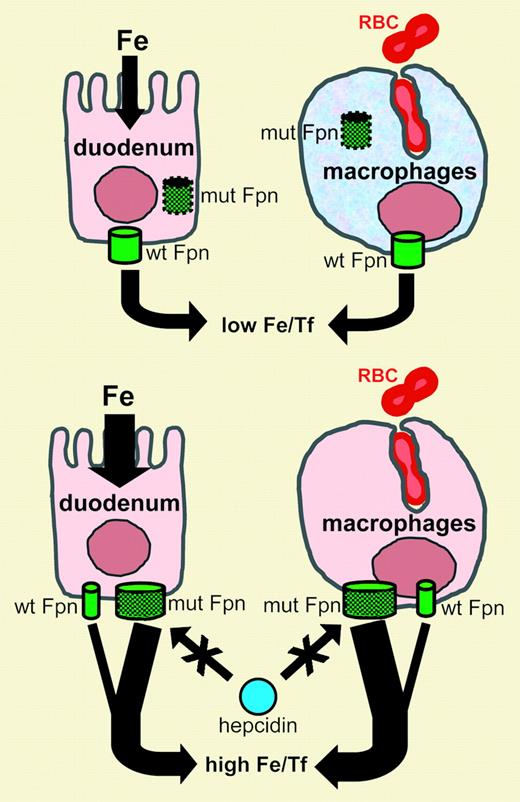 Proposed mechanism of the ferroportin disease pathogenesis. Top panel: a defect in trafficking (“loss-of-function”). Mutant protein is retained inside the cell resulting in a loss of iron export function. The efflux through the wild-type ferroportin represents only half of the normal amount and is inadequate for the macrophages processing large amounts of recycled iron. Iron accumulates in macrophages, leading to high ferritin levels, low transferrin saturation, and possibly borderline anemia. Anemia, in turn, might activate duodenal absorption, which would progressively increase transferrin saturation. Bottom panel: hepcidin resistance (“gain-of-function”). Mutations prevent hepcidin-mediated internalization and degradation of ferroportin either by interfering with hepcidin binding or by altering motifs required for internalization and degradation. As a result, an inappropriately high number of mutant ferroportin molecules is displayed on the cell surface, resulting in increased iron efflux from enterocytes and macrophages. Duodenal iron absorption increases, transferrin saturation rises, and excess iron is deposited in hepatic parenchyma and other tissues.