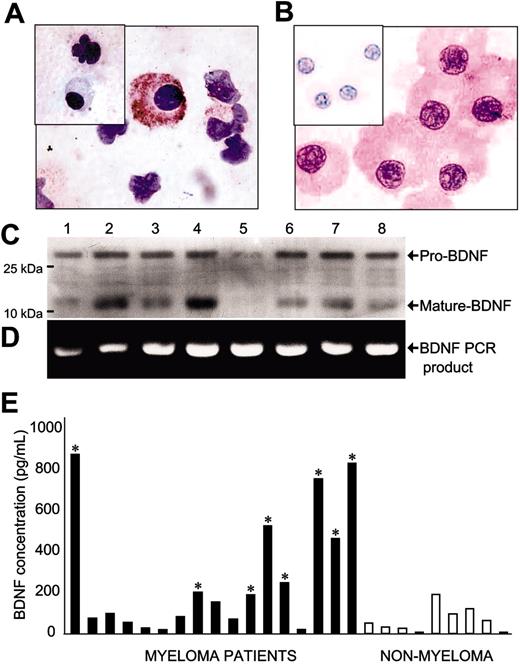 Figure 1. Expression of BDNF by malignant plasma cells. (A-B) Immunohistochemistry demonstrating BDNF expression by primary MM plasma cells. Representative cytospins of BM mononuclear cells freshly isolated from 2 patients with MM. Plasma cells show strong immunoreactivity using chicken anti–human BDNF but are not stained by chicken anti–human BDNF precleared with BDNF (inset). (C) Western blot demonstrating expression of both mature and pro-BDNF protein by HMCL. Expression was evident using either mouse anti-BDNF (shown) or rabbit (N-20) (not shown) antibodies. (D) Reverse transcriptase (RT)–PCR demonstrating BDNF mRNA expression by HMCL. No PCR products were evident in the absence of RT (not shown). (1) NCI H929, (2) RPMI 8226, (3) LP1, (4) ARP1, (5) OPM1, (6) KMS11, (7) JJN3, and (8) OPM2. (E) ELISA demonstrating increased BDNF in BM plasma of MM patients. Mean value for MM patients was 274 ± 71; patients without MM, 72 ± 22 (P < .05, Mann-Whitney test). * indicates significantly different from non-MM mean.