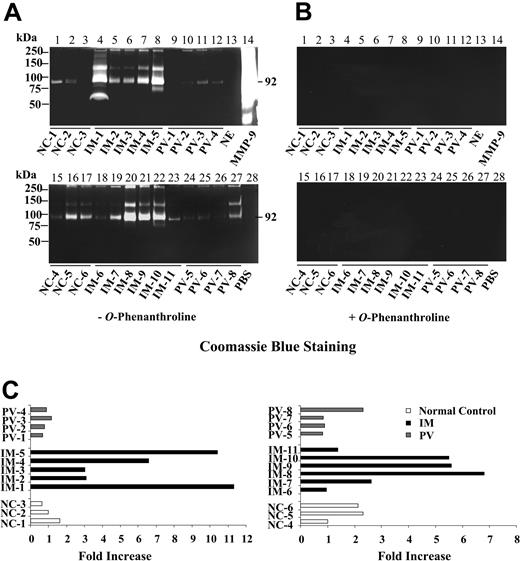 Figure 6. IM MNC-conditioned media contain elevated gelatinolytic activity, which is inhibited by an MMP inhibitor. (A) The gelatinolytic activities of media conditioned by PB MNCs from healthy volunteers (n = 6), patients with PV (n = 8), and patients with IM (n = 11); purified human NE; MMP-9; or PBS were analyzed by zymography. MNCs were incubated in serum-free IMDM at 37°C and 5% CO2 for 48 hours, and the cell-conditioned media or purified proteases were electrophoresed in 10% acrylamide containing 2 mg/mL gelatin in a cold room. Following electrophoreses, the gels were washed with 2.5% Triton X-100, renatured for 36 to 48 hours at 37°C, and stained with Coomassie blue. (B) Effect of the MMP inhibitor, o-phenanthroline, on the gelatinase activity of the media conditioned by the MNCs isolated from healthy volunteers (n = 6), patients with PV (n = 8), and patients with IM (n = 11); purified human NE; MMP-9. The parallel gels were incubated in the presence of 1.0 mM o-phenanthroline after electrophoresis. (C) Densitometric analysis of gelatinolytic activities (MMP-9). The intensities of the bands in the conditioned media by IM and PV were quantitated relative to the normal control and expressed as fold increase.