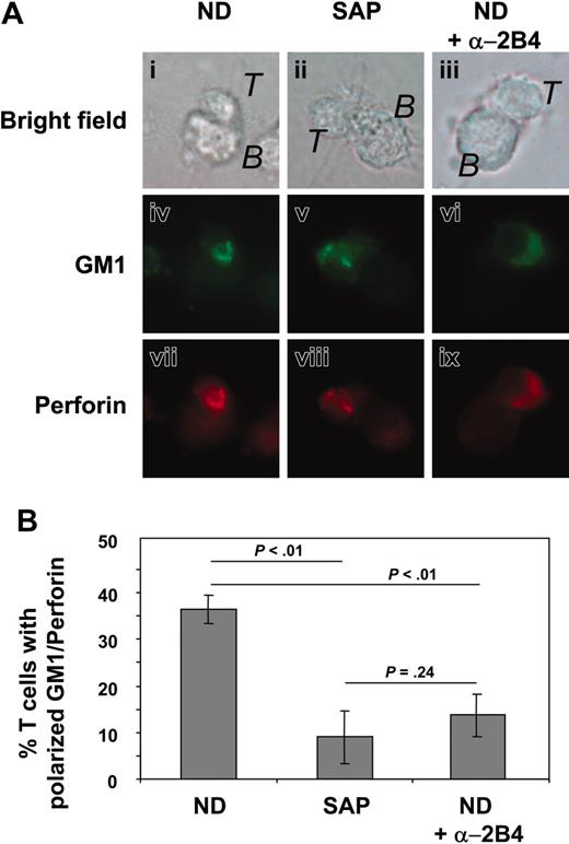 Figure 3. Distribution of perforin and GM1 in SAP-deficient CD8+ T cells. (A) GM1 and perforin distribution in normal and SAP-deficient CD8+ T cells (T) forming conjugates with EBV-positive B-cell line JY (B). The effects of blocking anti-2B4 mAbs on normal CD8+ T cells are also shown. One representative conjugate is shown in parallel as bright field (i-iii), GM1 staining (iv-vi), and perforin staining (vii-ix). (B) Quantitative analysis of GM1 and perforin coclustering at the area of contact with B-cell targets in T cells from 3 SAP-deficient patients and T cells from 3 healthy donors, either untreated or treated with blocking anti-2B4 mAbs. Cells were considered positive for coclustered GM1 and perforin if the staining was centered at the site of contact with the B cell and occupied less than one third of the cell surface. Data are represented as mean percentages (± SDs) of 3 experiments counting T cells forming clusters with a single JY B-cell target (for each cell line a total of 250-300 cells was counted). Statistical analysis was performed using an unpaired t test, and P values corresponding to the comparison of 1 group with the other are indicated.