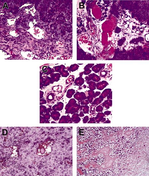 Figure 2. Development of thrombi in pancreatic tumors and colon adenocarcinomas. Rapamycin treatment results in the development of thrombi in orthotopic 3.6pl pancreatic tumors (A-C) and heterotopically implanted CT-26 colon adenocarcinomas (D-E). Representative high-magnification views of an area of pancreatic tumor from control and rapamycin-treated mice are shown. (A) No thrombi were found in control mice. (B) This photomicrograph shows several clotted vessels in a rapamycin-treated L3.6pl orthotopic tumor. (C) Areas of normal pancreatic tissue outside tumors in rapamycin-treated mice do not show evidence of vascular thrombosis. Similar patterns can be observed after short-term treatment with rapamycin in CT-26 tumor-bearing mice. (D) Unaffected vessels in control animals. (E) A central tumor necrosis is surrounded by viable tumor tissue containing thrombotic vessels. Total image magnification, 200×,20× Zeiss Achroplan objective lens, numerical aperture 0.45. Images were acquired with Image J software (rsb.info.nih.gov/ij).