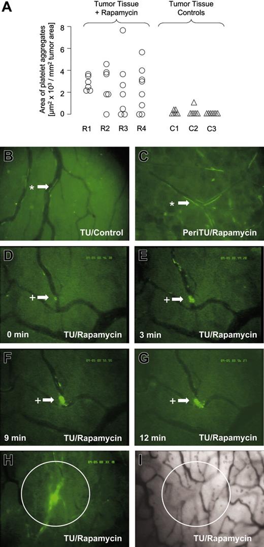 Figure 4. Adherence and aggregation of platelets occurs in tumor vessels but not in normal vessels after treatment with rapamycin. (A) The figure shows the total area of platelet aggregates related to tumor tissue area within a 30-second observation period, as an indicator for an ongoing coagulation process. Platelet aggregates were quantified in 6 to 8 random areas within the tumor (rapamycin R1-R4, ○; control C1-C3, ▵; n = 3-4) or the peritumoral tissue after 6 days of treatment. (B-I) Representative photomicrographs of the dorsal skinfold chambers are shown to illustrate the platelet endothelial interaction in the different groups. (B) In control animals platelets do not stick to tumor vessels; asterisk/arrow indicates flowing platelets. (C) In the peritumoral tissue of rapamycin-treated hamsters no plugging of vessels was observed. (D-G) Thrombus formation in the dorsal skinfold chamber tumors of rapamycin-treated hamsters are shown by sequential photomicrographs; +/arrow indicates adherent platelets (H-I). The overlay of identical sequences in trans- and fluorescent epi-illumination technique shows that thrombus formation is responsible for the observed loss of FCD in tumors. Total magnification for panels B-1, 630×, 20× Leitz Wetzlar long-distance objective lens, numerical aperture 0.32. Images were acquired with Image J software.