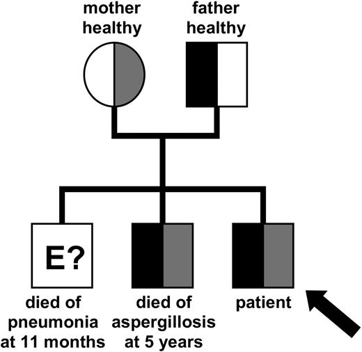 Figure 1. Inheritance of the mutated ARTEMIS alleles. Pedigree of the patient's family indicating the inheritance of the mutated ARTEMIS alleles. The genetic status of the eldest brother could not be determined at this point. Gray shaded areas indicate the affected maternal allele; black areas indicate the affected paternal allele.