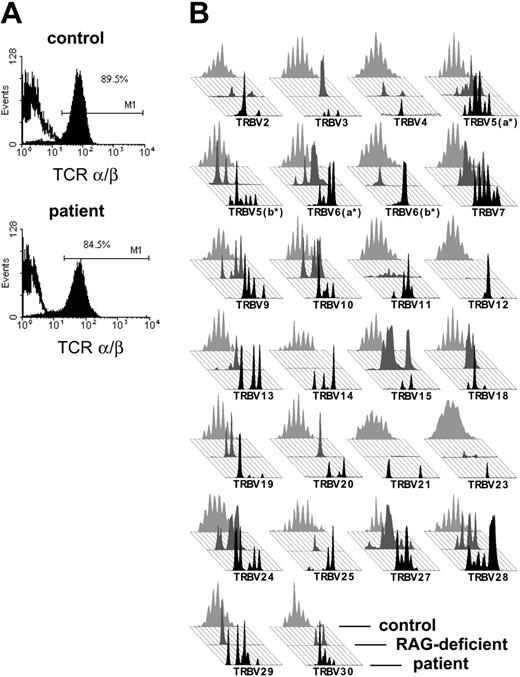 Figure 2. TCR expression of the patient with OS. (A) Cell surface staining of the TCRαβ on CD3+ T cells of the patient and a healthy control in immunofluorescence flow cytometry. The percentage of TCRαβ cells in PBMCs as well as the intensity of TCRαβ expressed is comparable between the patient's T cells and a healthy control. (B) Comparison of the TCR repertoire of our patient (in black, foreground) with a patient with OS with a RAG-deficient genotype (in dark gray, middle) and an age-matched healthy control (in light gray, background). The TCR repertoire of the patient is severely restricted and matches the pattern of a RAG-deficient patient with OS, while the repertoire of the healthy control displays a Gaussian distribution.