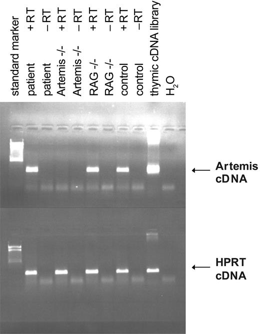 Figure 4. ARTEMIS RNA expression of the fibroblasts of the patient with OS. Reverse transcriptase–PCR of ARTEMIS RNA derived from fibroblasts of the patient with OS, an ARTEMIS-deficient patient, a RAG-deficient patient, and an age-matched healthy control. Amplification from a thymic cDNA library and H2O served as positive and negative controls, respectively. Transcription was performed with (+RT) and without (-RT) reverse transcriptase. Equal usage of cDNA was tested by amplifying HPRT cDNA.