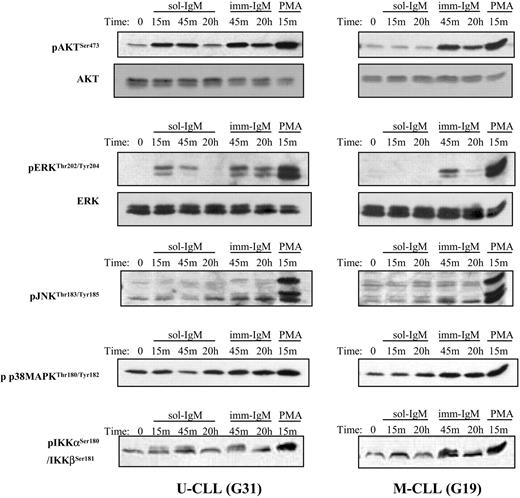 Figure 3. Activation of AKT, ERK, IKKα/β, JNK, and p38 MAPK after BCR stimulation with sol- and imm-IgM. Immunoblot analysis is shown for one CLL case with unmutated (G31) and one case with mutated (G19) VH genes. Stimulation was done with sol-IgM for 15 minutes, 45 minutes, and 20 hours, and with imm-IgM for 45 minutes and 20 hours, as described in “Patients, materials, and methods.” Stimulation with PMA (1 μM) was used as a positive control. The antibodies against the phosphorylated and total proteins used for immunoblotting are indicated on the left.