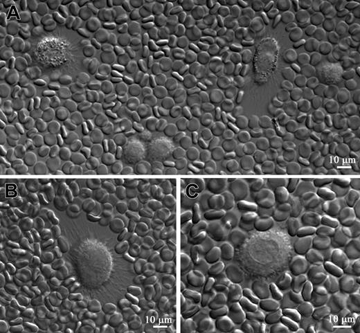 Figure 5. HAS1-expressing MM B cells synthesize a pericellular HA matrix. The HA pericellular matrix around the cell was visualized by the addition of fixed erythrocytes to sorted CD19+ B cells from MM (n = 15) and healthy donors (n = 3) and from MM CD38hiCD45lo PCs (n = 3) in short-term culture. Fixed erythrocytes were physically excluded from the areas surrounding a cell that had synthesized an HA pericellular matrix. HA matrix was detected only around MM CD19+ B cells. MM BM CD38hiCD45lo PCs and CD19+ B cells obtained from healthy donors did not exhibit an HA matrix around their plasma membranes (results not shown). Furthermore, no HA matrix was detected around the MM CD19+ B cells at 4 hours and 12 hours of culturing; however, 24 hours later, a small amount of HA matrix was detected around some MM CD19+ B cells, while other B cells in the culture did not exhibit an HA matrix. The size of an HA matrix significantly increased around some MM CD19+ B cells 48 hours after culture (A, arrows; B), while other CD19+ B cells did not develop an HA matrix (A, stars). In the culture some cells were characterized by a prominent coat of HA at one edge of the cell, while the opposite edge of the same cell exhibited lesser amounts of HA matrix (B). This type of distribution of HA matrix around the cells results from cell motility. Motile cells exhibit a prominent HA halo at their trailing edge and a lesser pronounced halo at their leading edge. After HAase treatment no HA matrix was detected around MM CD19+ B cells (C). Scale bar = 10 μm. Magnification 40×, numerical aperture 1.3. Images were processed using LSM 510 software.