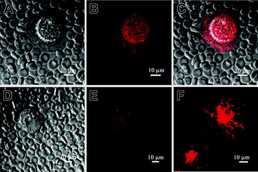 Figure 6. Pericellular matrix synthesized by MM B cells includes HA: MM B cells express intracellular HA. PEA in combination with indirect HA staining was used to verify the existence of HA molecules in the pericellular matrix detected by PEA on Figure 2. MM CD19+ B cells were cultured for 48 hours and then were incubated with B-HABP. HA binding to B-HABP was visualized using streptavidin Alexa 594. (A) CD19+ B cell without HA staining. (B) The cell and pericellular matrix around MM CD19+ B cells, which excluded fixed erythrocytes, were stained with streptavidin Alexa 594, indicating the presence of HA in the pericellular matrix. (C) Merged image of PEA and HA staining. (D) The cells were treated with HAase, which degraded the HA pericellular matrix. (E) HAase treatment also diminished cell surface HA staining. (F) Staining cells with B-HABP also detected intracellular HA in permeabilized MM CD19+ B cells. The staining pattern suggests that intracellular HA is distributed along the cell cytoskeleton and perinuclear compartment of MM B cells. Additionally, for one MM patient, weak nuclear staining of HA was observed in CD19+ B cells (not shown). Scale bar = 10 μm. Magnification 40×, numerical aperture 1.3. Images were processed using LSM 510 software.