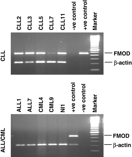 Figure 1. Expression profile of fibromodulin mRNA in leukemic cells. B-CLL (n = 5), ALL (n = 2), and CML (n = 2) patients and healthy control donor (NI 1). Positive (+ve) controls represent the PCR product cloned into pGEM-T easy vector (top panel). B-CLL pooled cDNA (bottom panel). Negative (-ve) control is the reaction mix without template. Marker is a 100-bp DNA ladder. FMOD indicates fibromodulin.